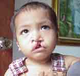 Key KidFoundation.org, fix Cleft Palates, Fix Faces with our Facial Surgery Project